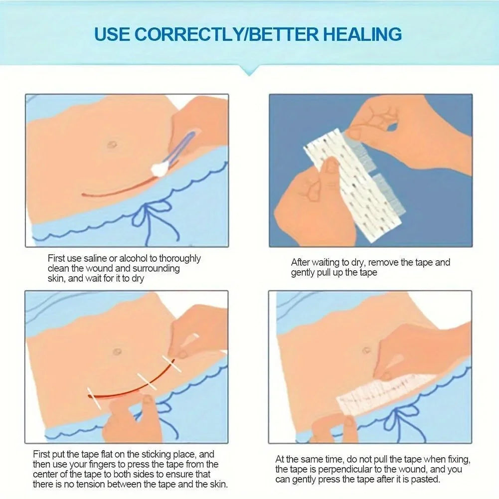 Wound Closure Tape Adhesive Sterile Medical Bandage